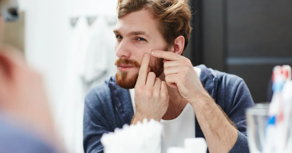 A beautiful gen z man is showing pimple on his face